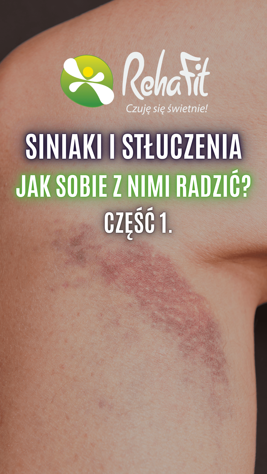 stłuczenia